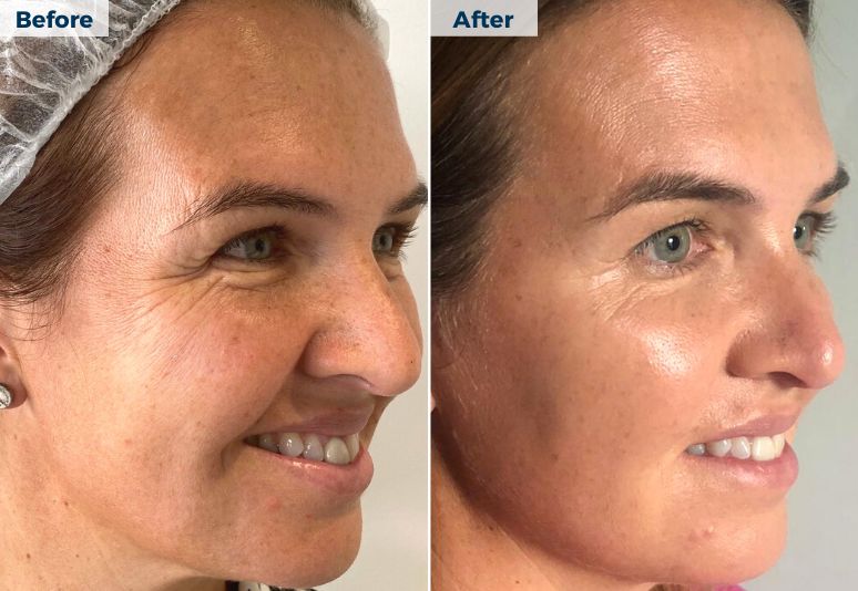 NanoNeedling National Skin Cancer Centres